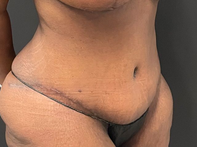 Abdominoplasty Before & After