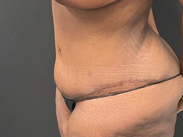 Abdominoplasty Before & After