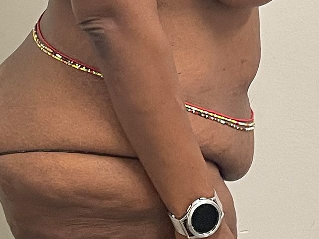 Abdominoplasty Before & After