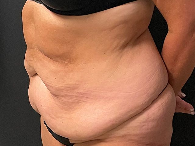 Abdominoplasty Before & After
