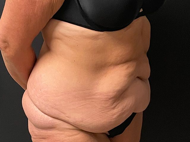 Abdominoplasty Before & After