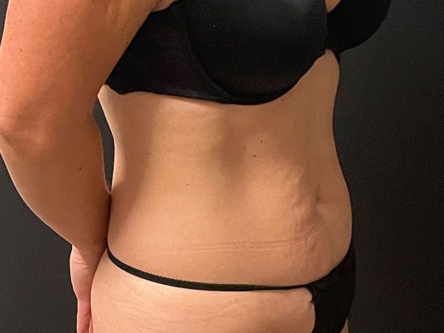 Abdominoplasty Before & After