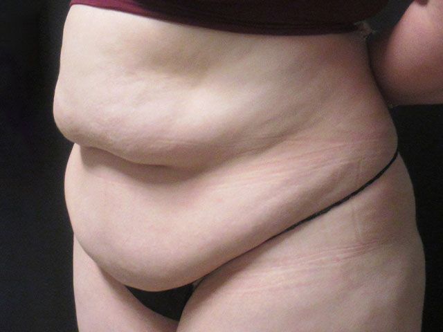 Abdominoplasty Before & After