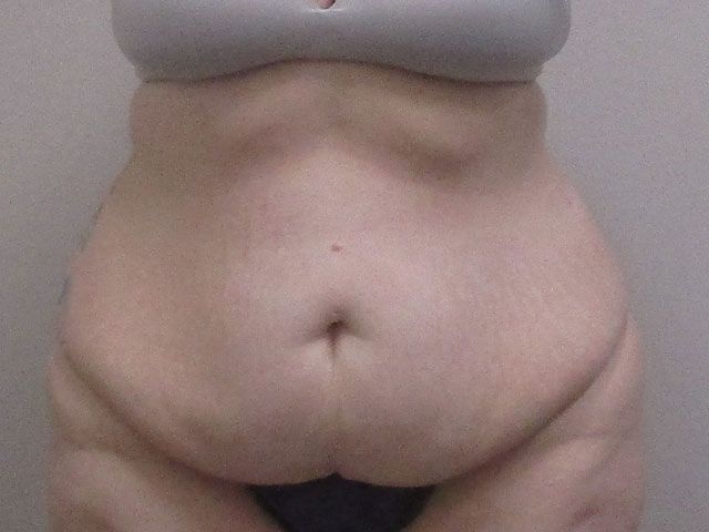 Abdominoplasty Before & After