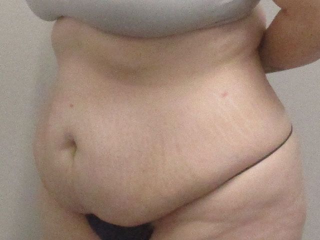 Abdominoplasty Before & After