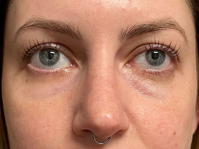 Under Eye Before & After