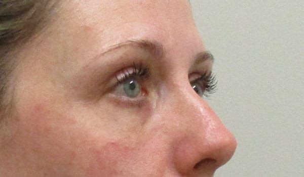 Under Eye Before & After