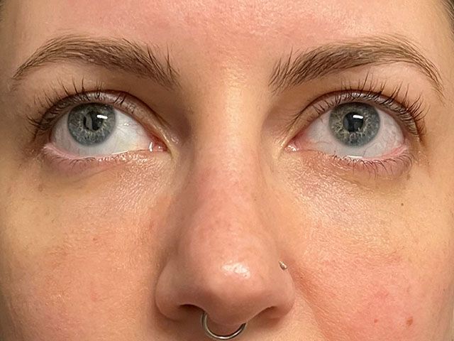 Under Eye Before & After