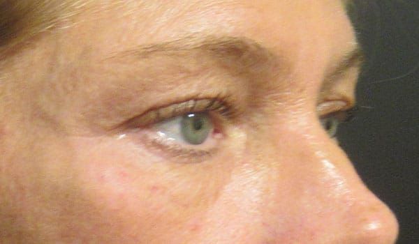 Under Eye Before & After