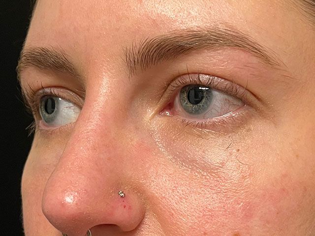 Under Eye Before & After