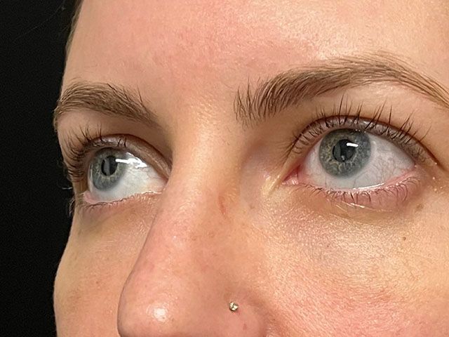 Under Eye Before & After