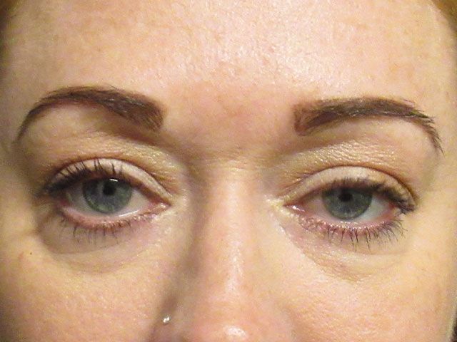 Under Eye Before & After