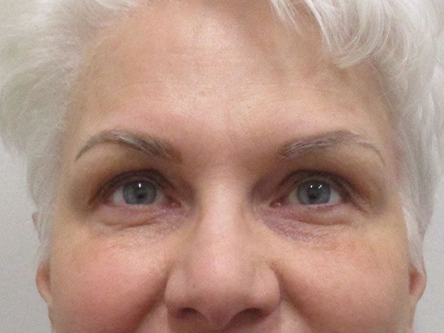 Under Eye Before & After