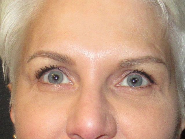 Under Eye Before & After