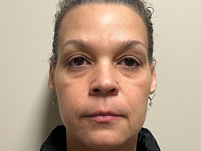 Under Eye Before & After