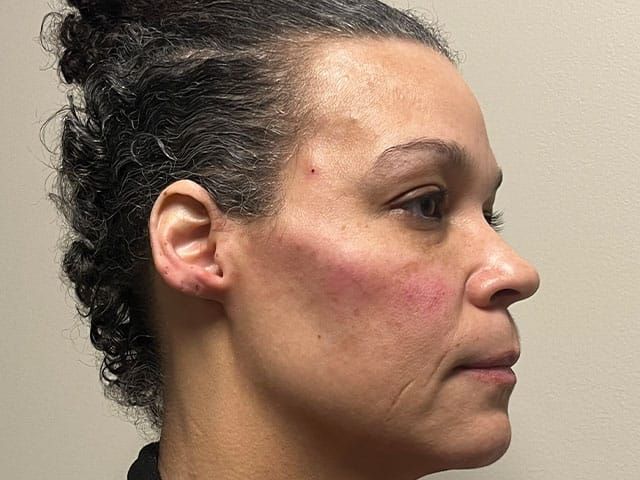 Under Eye Before & After