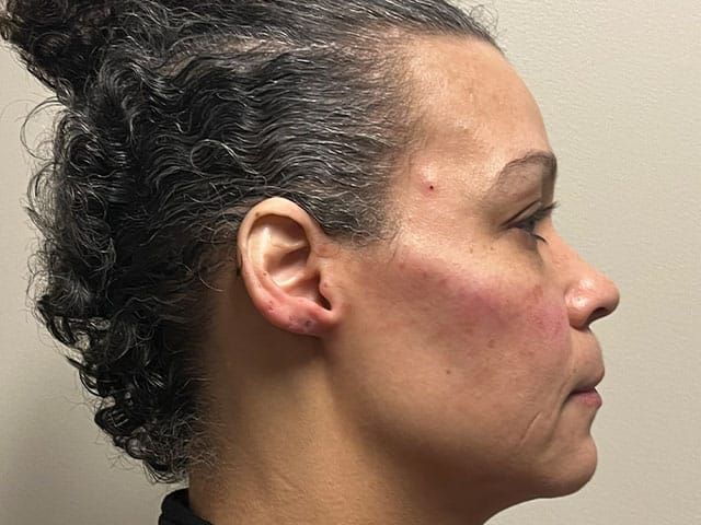 Under Eye Before & After