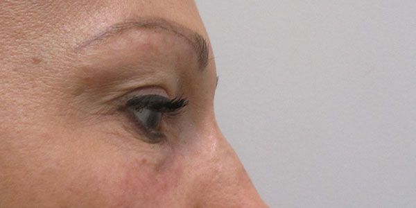 Under Eye Before & After