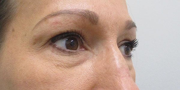 Under Eye Before & After