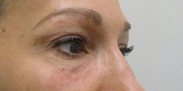 Under Eye Before & After