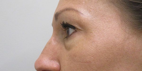 Under Eye Before & After