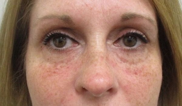 Under Eye Before & After