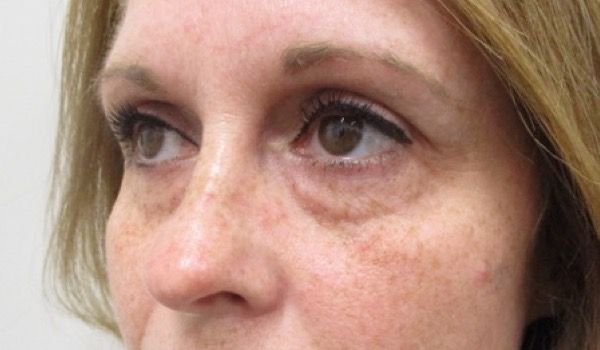 Under Eye Before & After