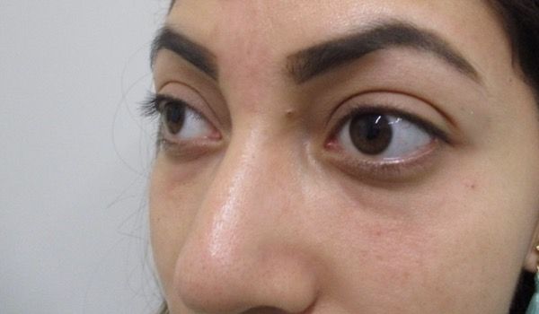 Under Eye Before & After