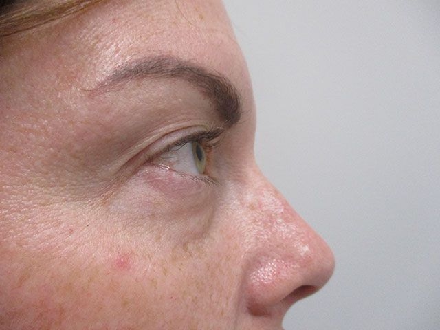 Under Eye Before & After