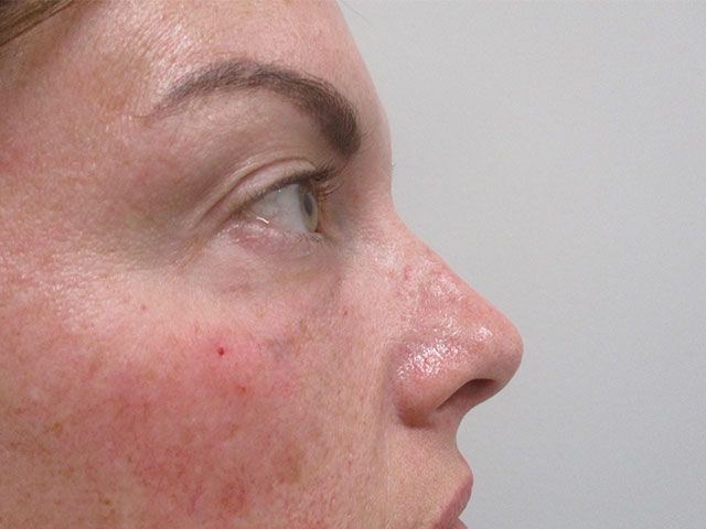 Under Eye Before & After