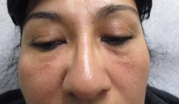 Under Eye Before & After