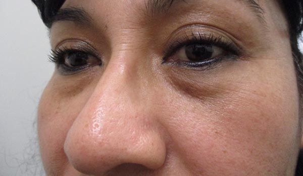 Under Eye Before & After