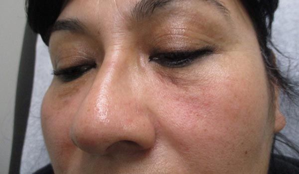 Under Eye Before & After