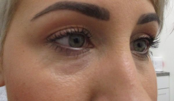 Under Eye Before & After