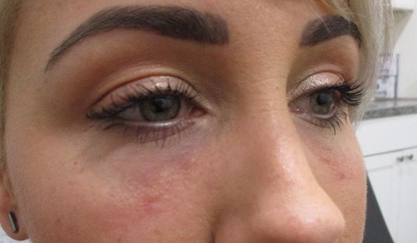 Under Eye Before & After