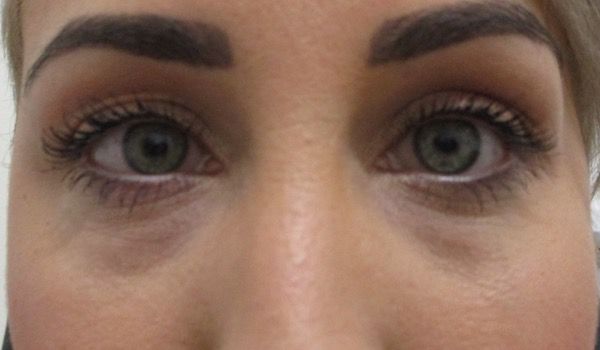 Under Eye Before & After