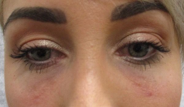 Under Eye Before & After