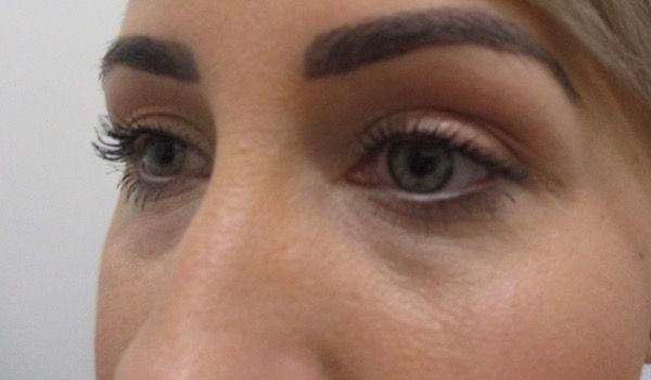 Under Eye Before & After