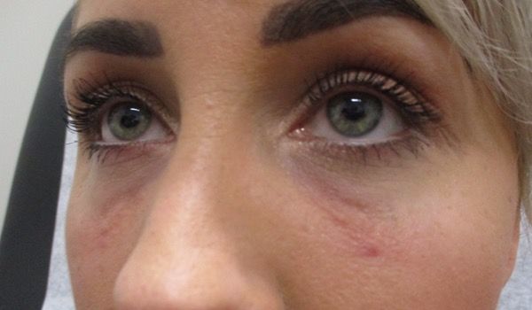 Under Eye Before & After