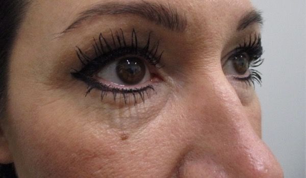 Under Eye Before & After