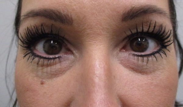 Under Eye Before & After