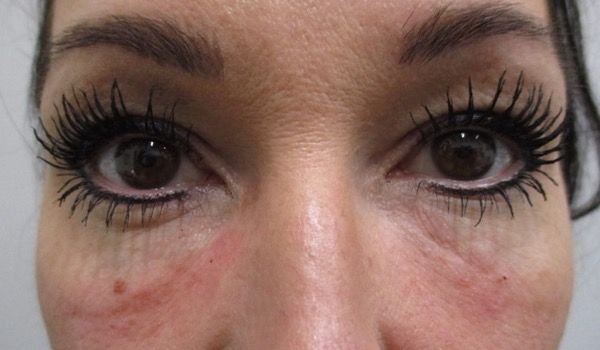 Under Eye Before & After