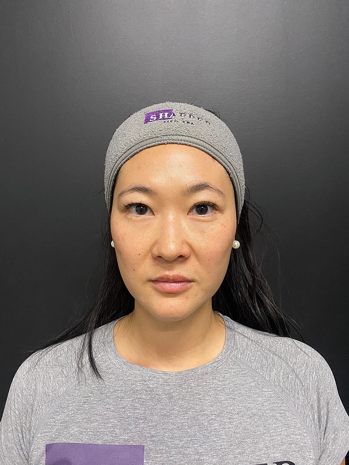 Masseter Tox Before & After