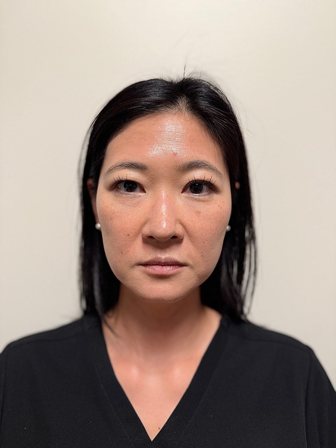 Masseter Tox Before & After