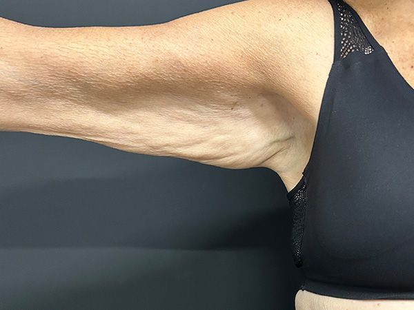 Morpheus8 Body Before & After