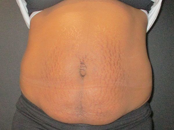 Morpheus8 Body Before & After