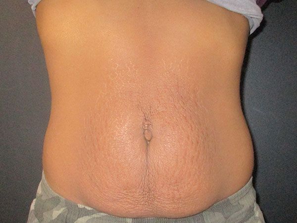 Morpheus8 Body Before & After