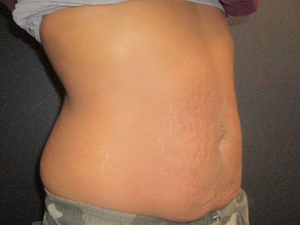 Morpheus8 Body Before & After