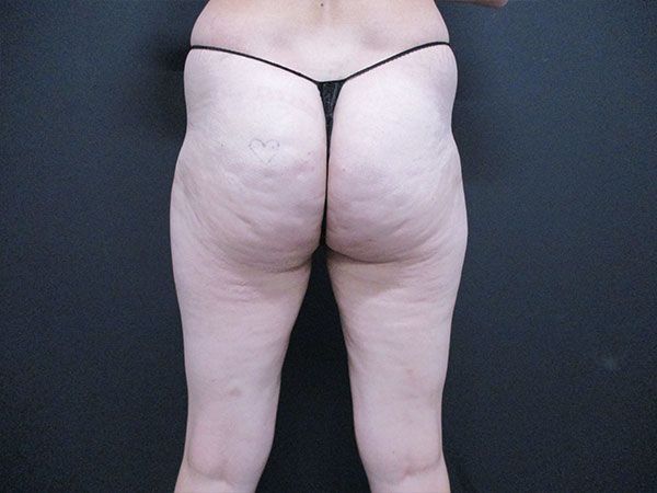 Morpheus8 Body Before & After