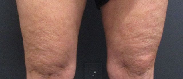 Morpheus8 Body Before & After